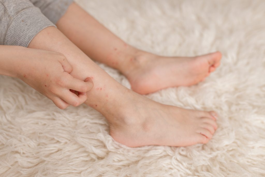 How to Tell Flea Bites on Humans From Every Other Itchy Bump
